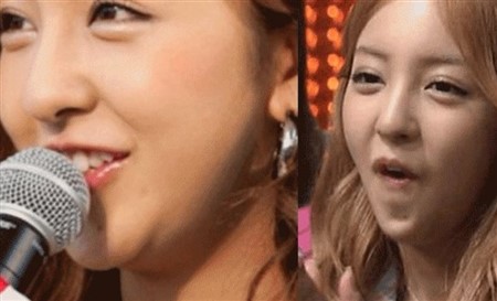 芸能人 整形失敗