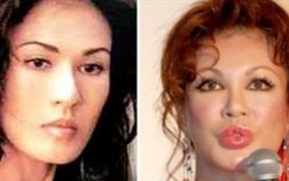 芸能人 整形失敗